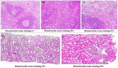 Case report: Kimura's disease with minimal degenerative glomerulopathy without eosinophil infiltration responds to mycophenolate mofetil treatment